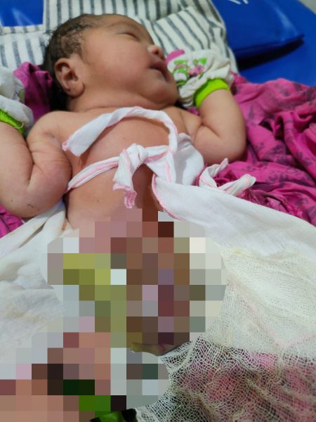 Bayi Penderita Gastroschisis Lebih Berarti Daripada Sebuah Proyek Pembangunan