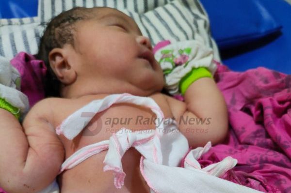 Bayi Penderita Gastroschisis Lebih Berarti Daripada Sebuah Proyek Pembangunan